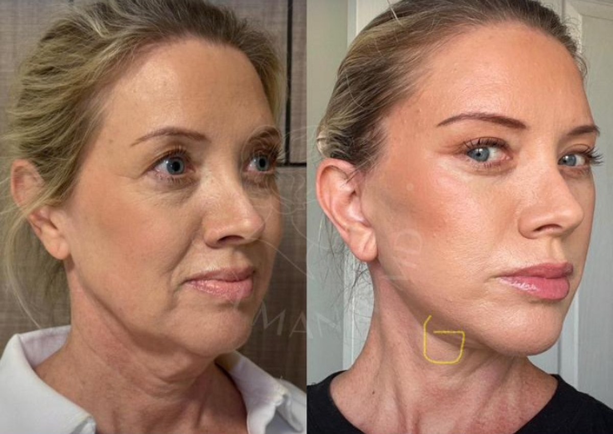 Before and after facelift surgery in Istanbul — patient case 2