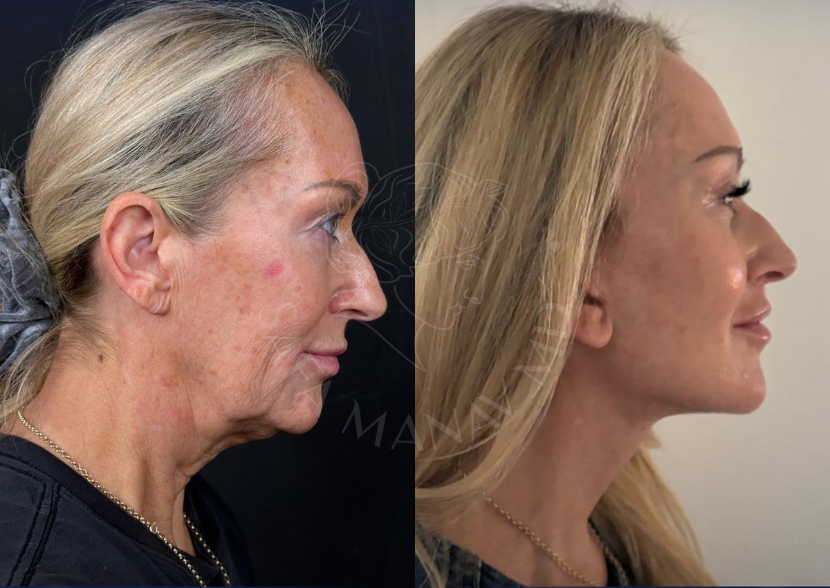 Before and after facelift surgery in Istanbul — patient case 3
