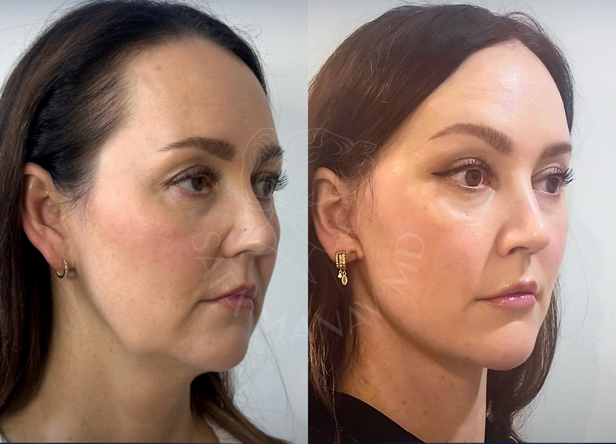 Before and after facelift surgery in Istanbul — patient case 4