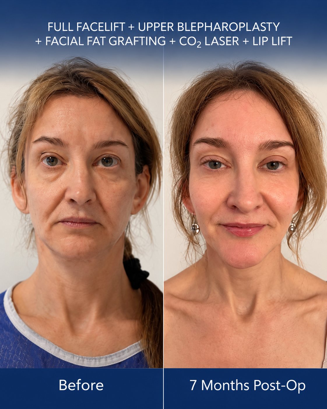 Front-facing before and after photo of a deep plane facelift patient in Istanbul