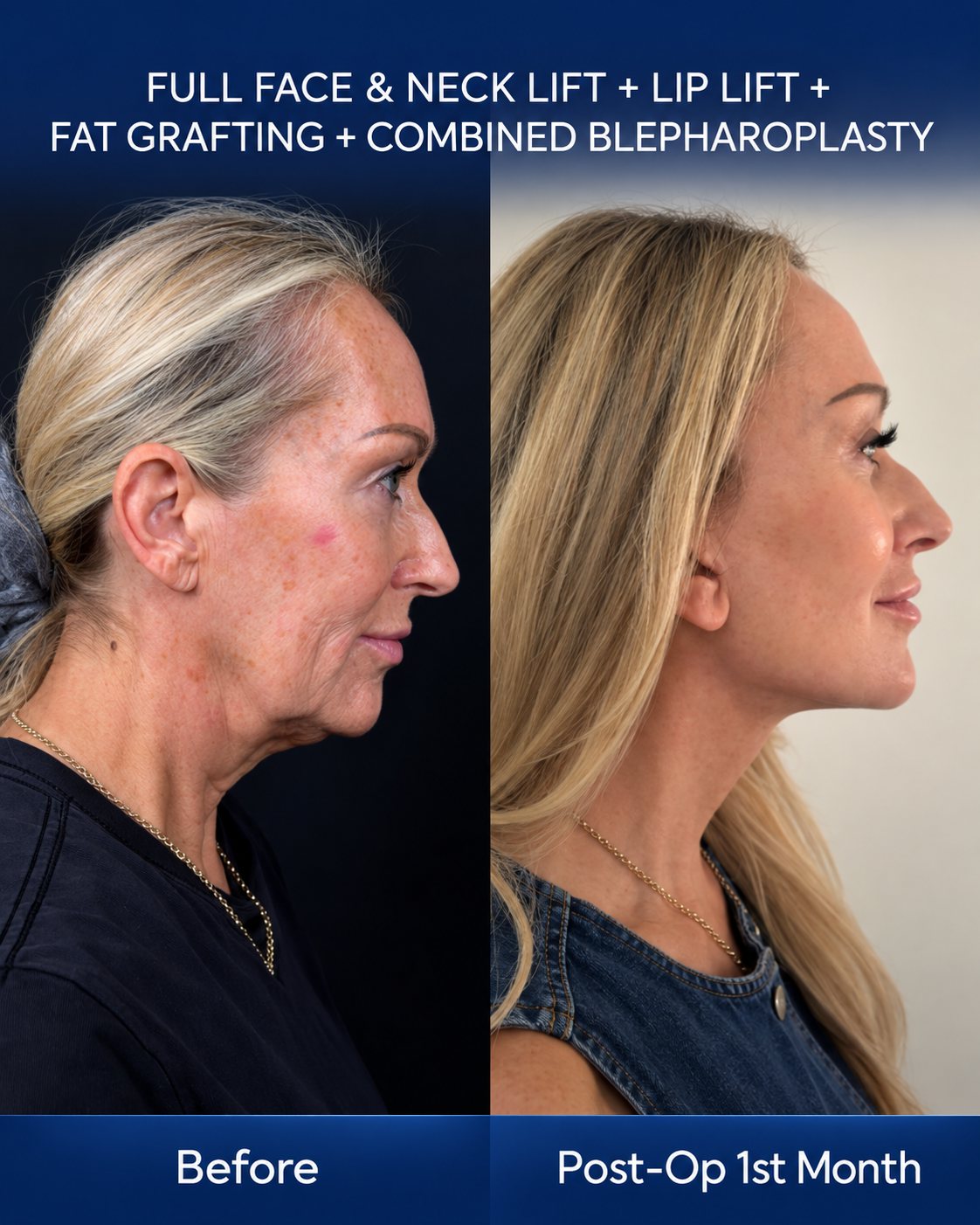 Profile before and after photo of a facelift patient showing neck and jawline definition